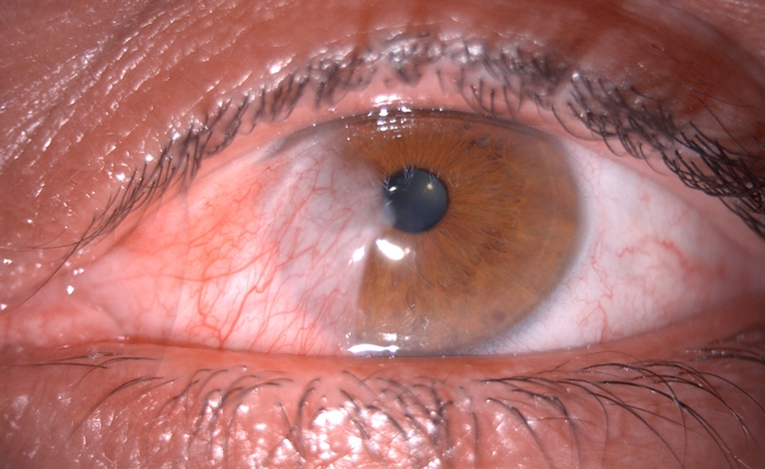 Pterygium