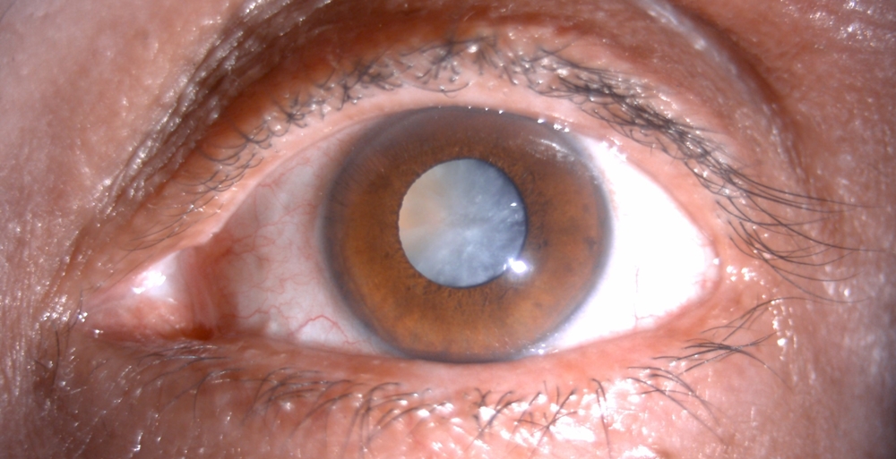 Cataract