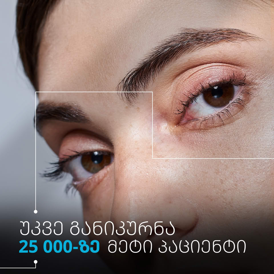 ფაკიური ლინზის (ICL) იმპლანტაცია